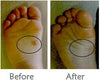 Wellinhand Wart Wonder